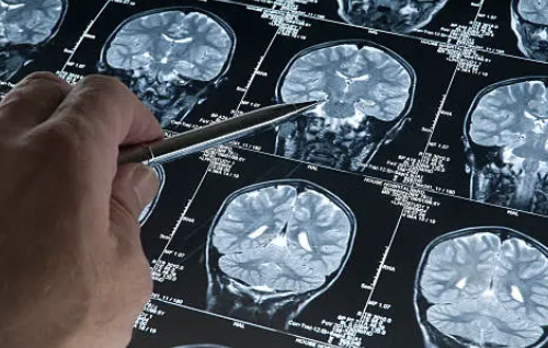 Alzheimerův předobraz v mladém věku