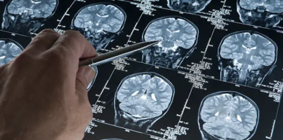 Alzheimerův předobraz v mladém věku